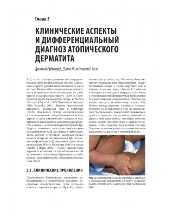 Атопический дерматит и экзематозные расстройства