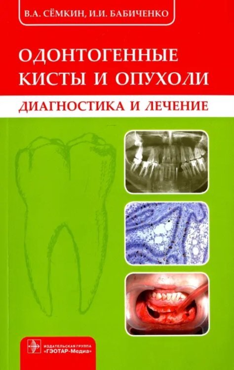Одонтогенные кисты и опухоли. Диагностика и лечение