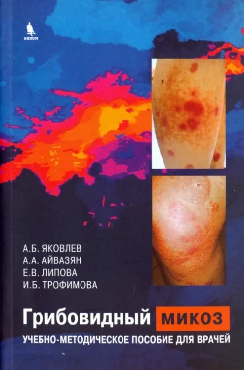 Грибовидный микоз. Учебно-методическое пособие для врачей