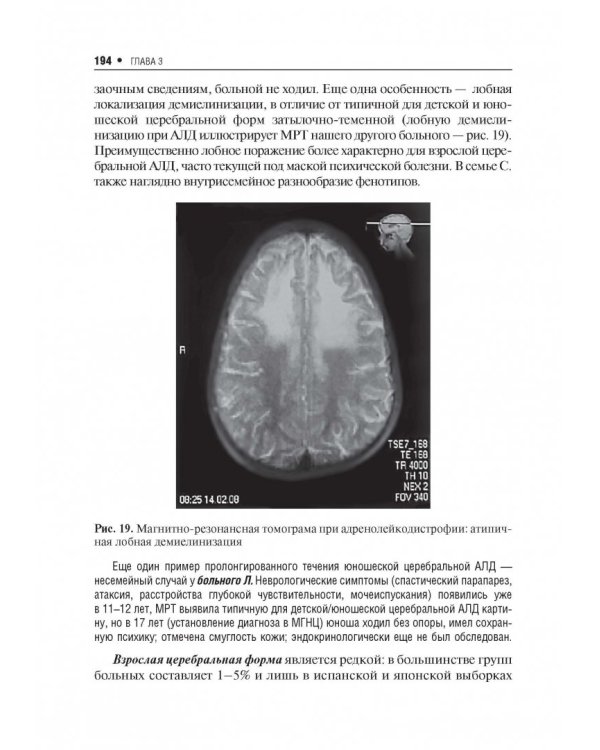 Наследственные нейрометаболические болезни юношеского и взрослого возраста