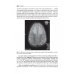 Наследственные нейрометаболические болезни юношеского и взрослого возраста