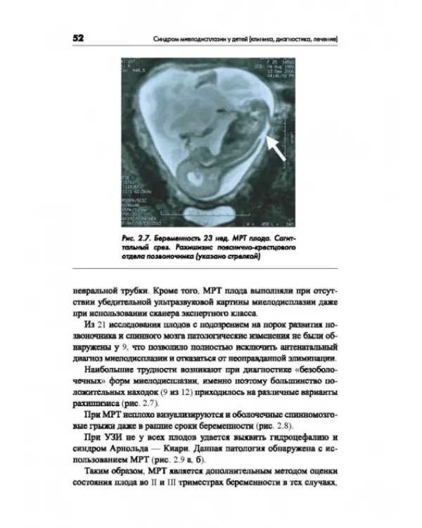 Синдром миелодисплазии у детей (клиника, диагностика, лечение)