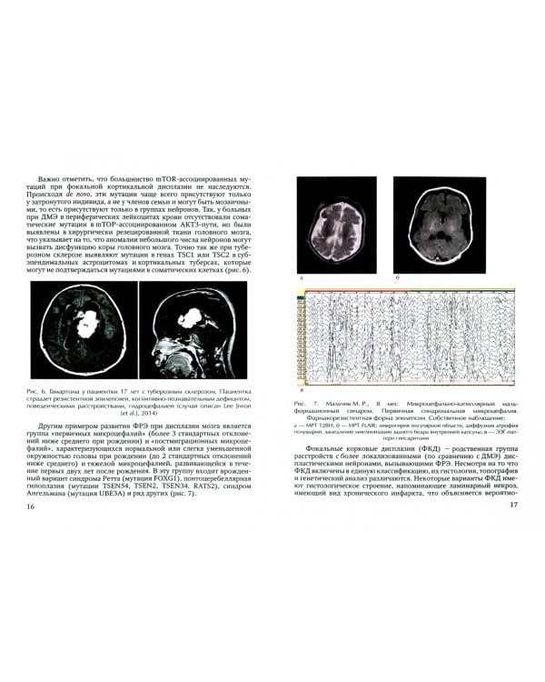 Резистентные формы эпилепсии у детей (диагностика, лечение). Учебное пособие