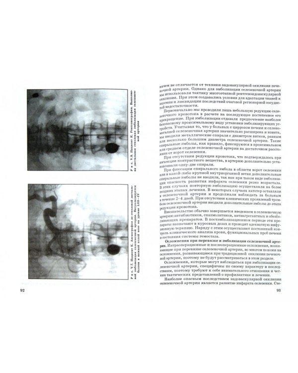 Современные методы хирургической коррекции асцитического синдрома при циррозе печени