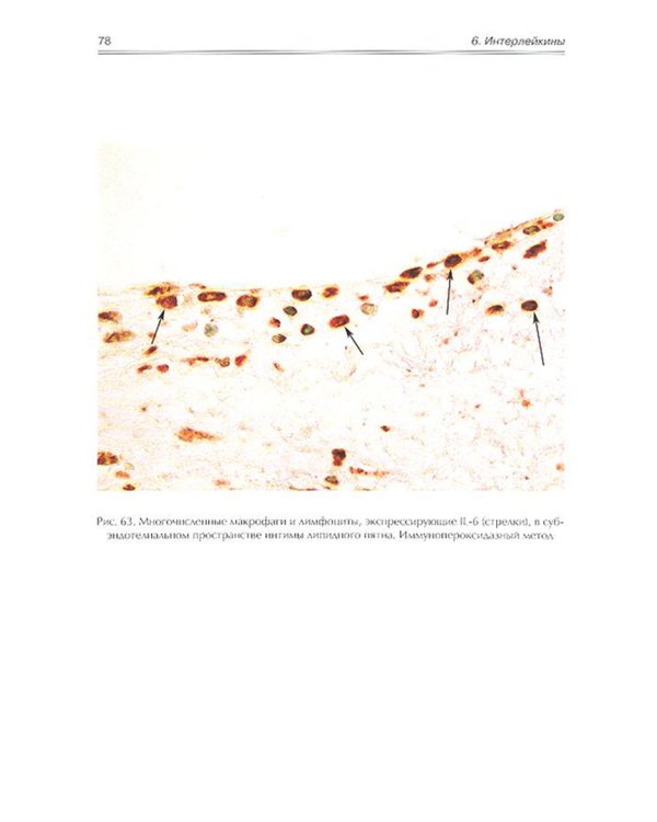 Атеросклероз. Нестабильная атеросклеротическая бляшка (иммуноморфологическое исследование). Атлас