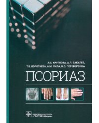 Псориаз